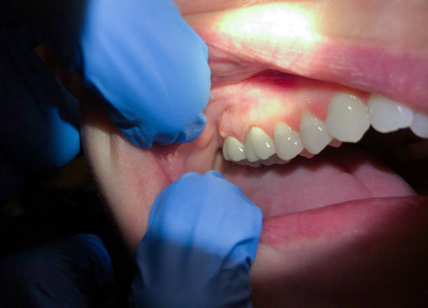 Best Emergency Treatment for Toothache in Crimora, VA